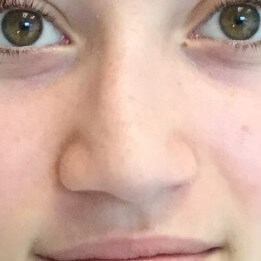 nose fracture Dr Suzman Patien